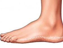 Prevention measures for foot fungus